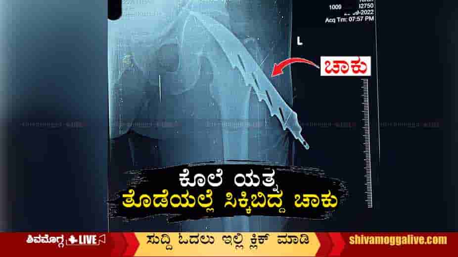 x-ray-of-kiran-Bhadravathi-case-at-Antaragange